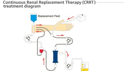 CliniNephrology's tweet photo. #Interesting Timing or Modality of Renal Replacement Therapies in Critically Ill Patients
Get to know @ https://t.co/u1TXIZzFDM https://t.co/dvtmgtWSO0