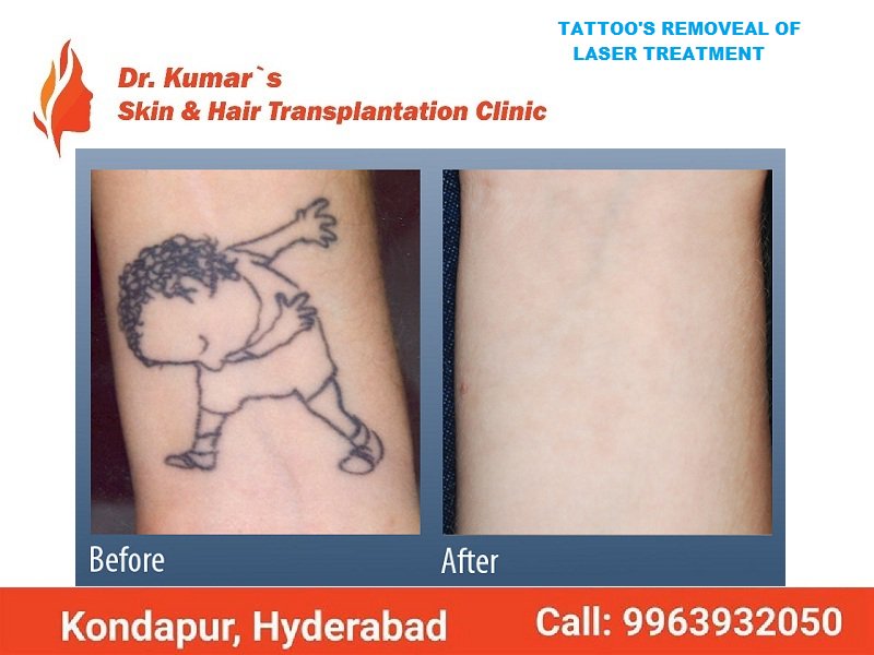 drashokkumar143's tweet image. Tattoo Removal Of Laser Treatment in Hyderabad
thehaircare.co.in
Best Skin Treatment in Hyderabad. 
#tattoo_Removal
#tattoo_treatment