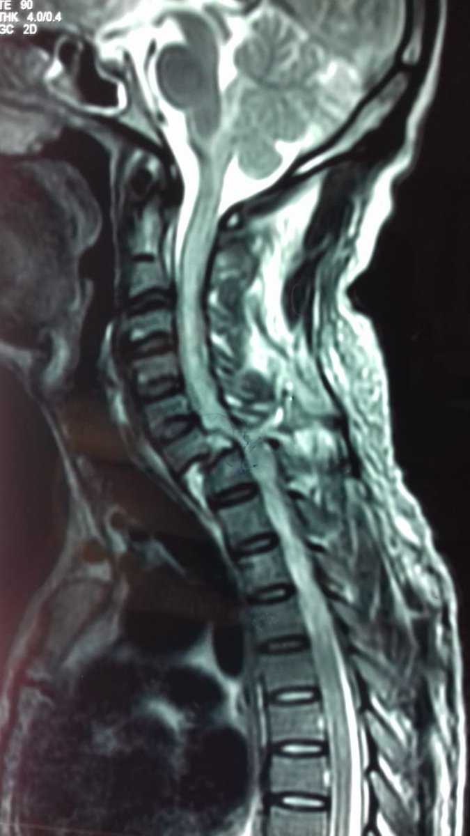 Dr Dinesh Arora (@drdineshias) on Twitter photo 40 yr male at Bokaro suffered cervical injury due to fall from roof. He had C7 vertebra severe cord compression & quadriplegia. The patient was promptly operated wt implant under #AyushmanBharat at RIMS Ranchi free of cost. Patient recovering well.<a href="/PMOIndia/">PMO India</a> <a href="/ibhushan/">Indu Bhushan</a> <a href="/amitabhk87/">Amitabh Kant</a> 40 yr male at Bokaro suffered cervical injury due to fall from roof. He had C7 vertebra severe cord compression & quadriplegia. The patient was promptly operated wt implant under #AyushmanBharat at RIMS Ranchi free of cost. Patient recovering well.<a href="/PMOIndia/">PMO India</a> <a href="/ibhushan/">Indu Bhushan</a> <a href="/amitabhk87/">Amitabh Kant</a>