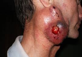 Head_NeckCancer's tweet photo. MEDI0457 with Anti-PD-1 Therapy Shows Promise in Treating #HPV -associated Head and Neck #Cancer https://t.co/hdoZlLwOvi https://t.co/JPaEh7xLG7