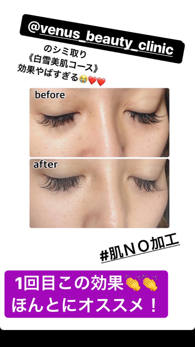 Venusbeautyclinic Twitter Search Twitter