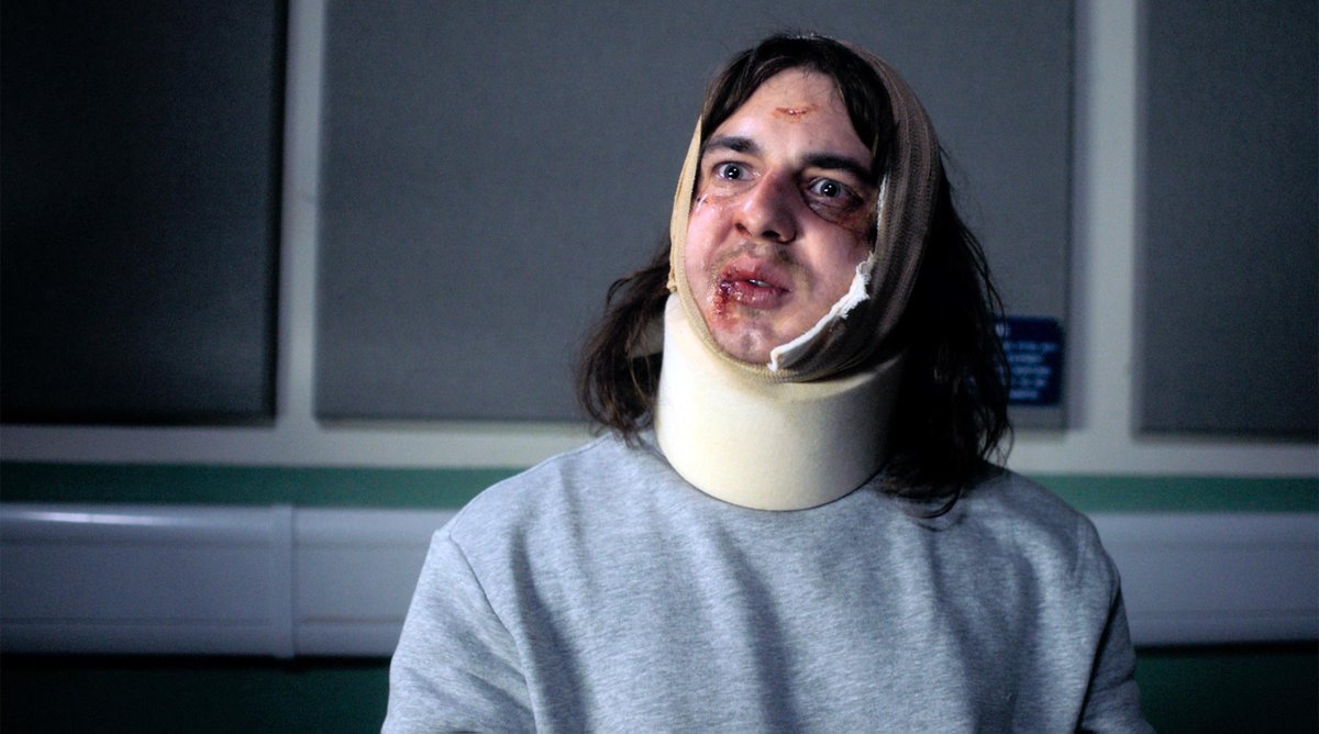 4Viewers's tweet photo. Some nasty injuries there Dean...all is definitely what it seems... #NoOffence https://t.co/FXTwvTd2B9