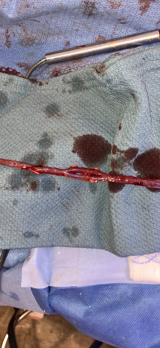 Neat variant: bifid system in SSV conduit for pop-pedal bypass #vascular #CLIfighters