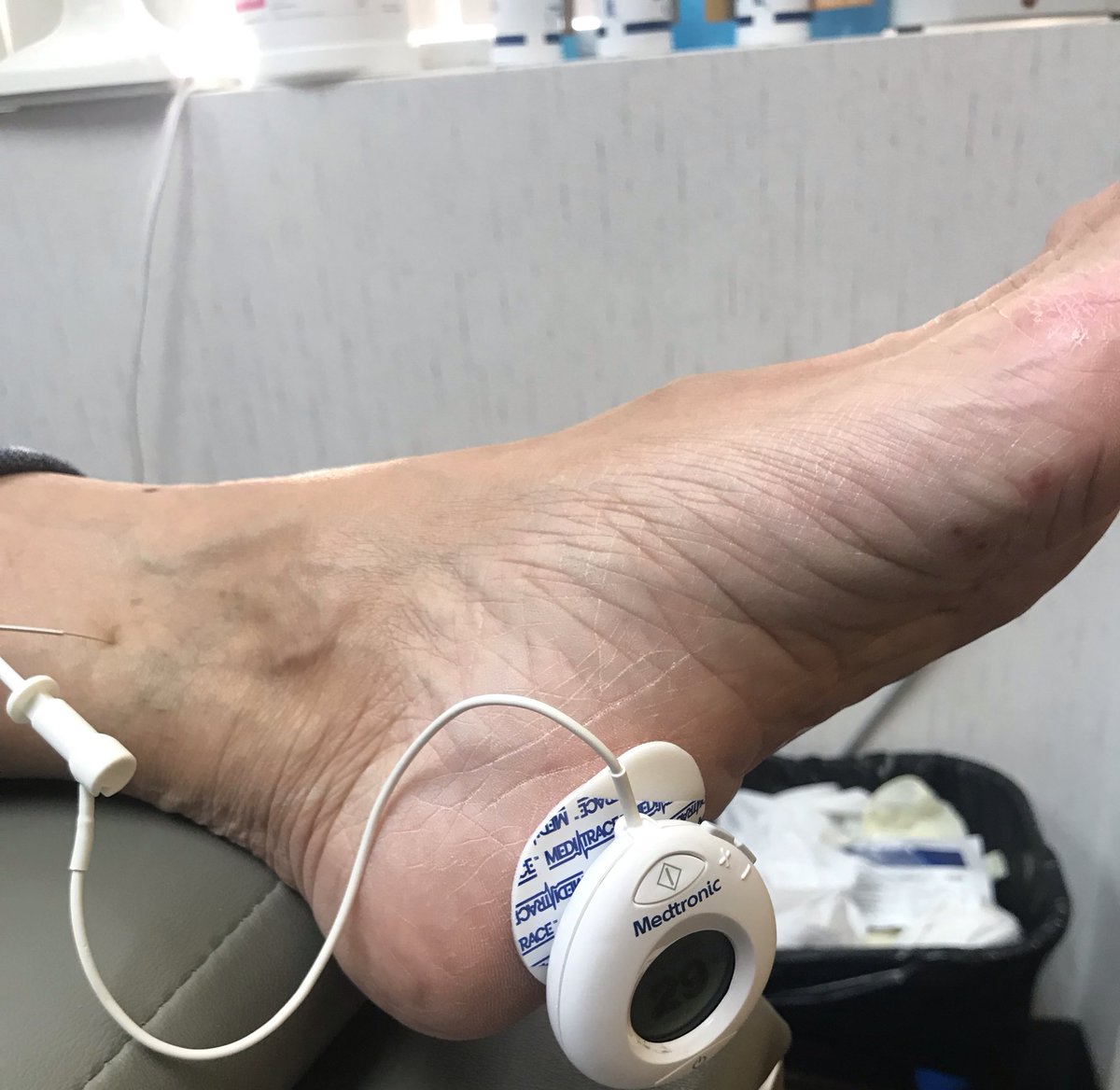 draarongrotas's tweet photo. #ptns #oab #medicinefree #nervestimulation #peripheral #sacral #nerve #gottago #goless https://t.co/4JtLyzBPfK