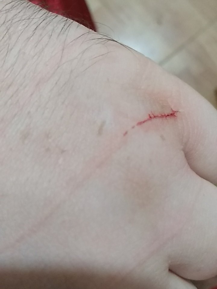 RichardoA7X's tweet photo. Encontrarte a esta Mojona de gata comiendo así, agarrarla para acariciarla un poquito (Ya habiendo acabado de lamer) y recibir este ataque. Para la próxima me acerco con un traje antiradiacion a ver si no me desangro. https://t.co/p8otXur7nX