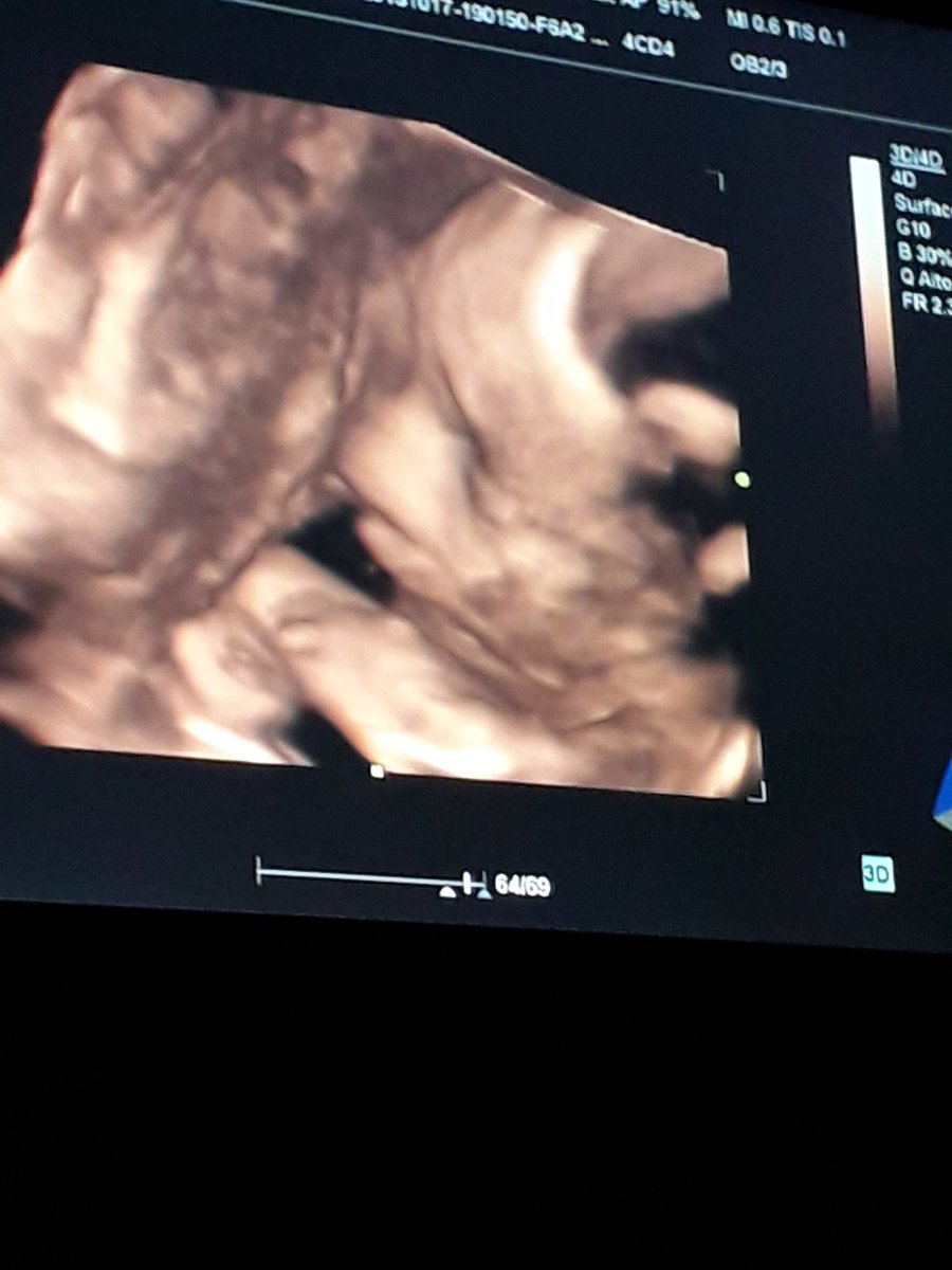 MariaferS29's tweet photo. A mamá o papá?
23 weeks 💕 https://t.co/MB9JLrj2Le
