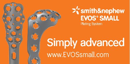 smithnephew's tweet photo. TOMORROW 10/20 is the last chance for #OTA2018 attendees to get a live demo of #EVOSSmall bone plating system. Are you looking for a new solution in #TraumaFixation? Find us in booth 805 with your questions, or get full info here: https://t.co/BvmRsAOm8P https://t.co/B1Q0L4Sf15