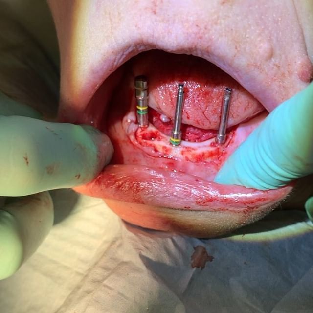 drpeyray's tweet photo. #fullarchfriday I'm sure you are biting at the bit to know more of what's going on. Check out the story for a nibble more. #dentistry #mynewsmile https://t.co/PYyT7V5cdP https://t.co/tPXJDJkcqf