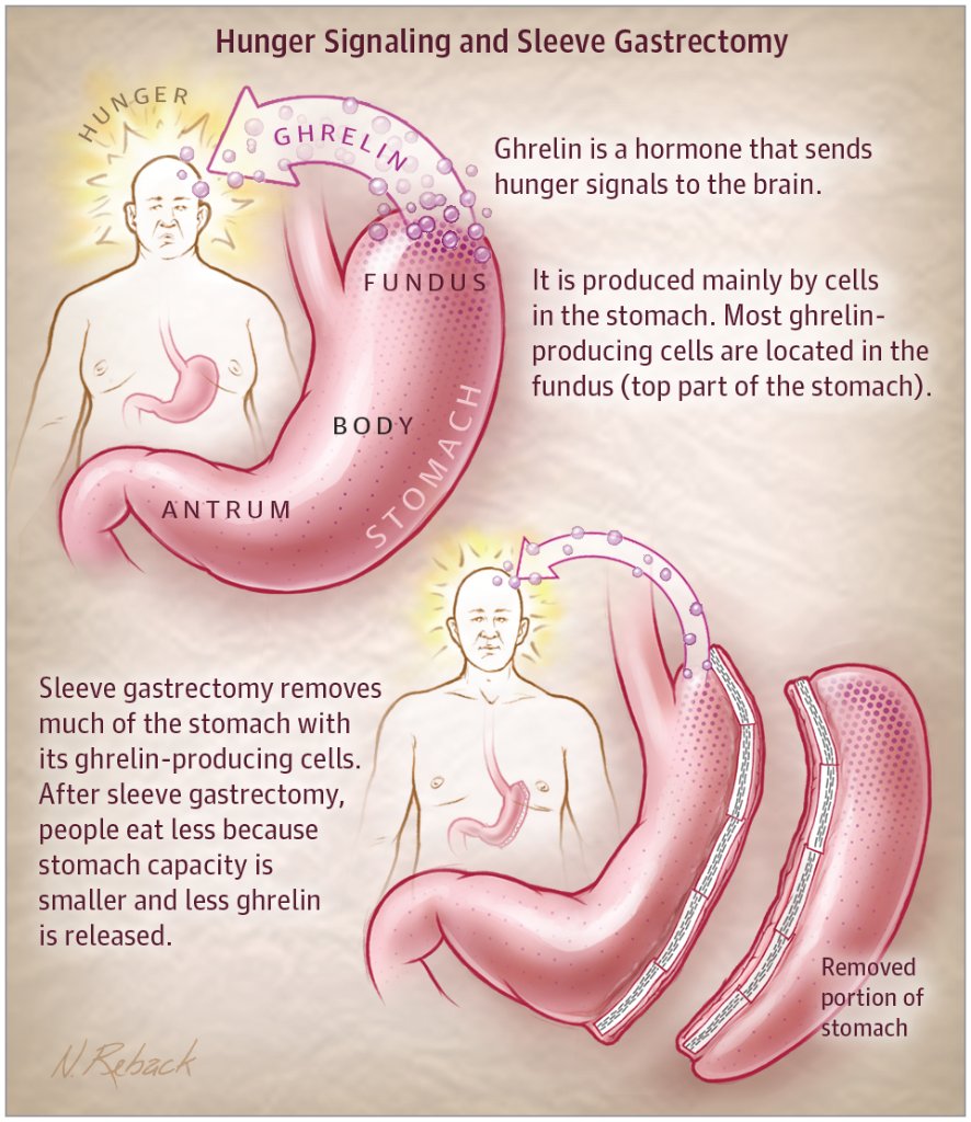 Aggressive medical treatment of type 2 #diabetes is modestly effective and very expensive. Evidence for the efficacy of #bariatricsurgery for management of #T2DM is coming into focus, and insurance coverage for the procedures should be expanded. ja.ma/2pW3hUp