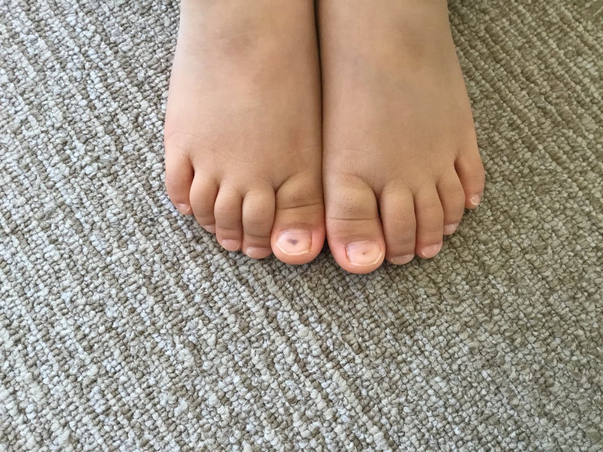 片野貴夫 En Twitter 3歳の女の子の親指の爪に黒い点が出ているのは 股関節の靭帯の片側の緩みが原因でした 片野貴夫 En Twitter 3歳の女の子の親指の爪に黒い点が出ているのは 股関節の靭帯の片側の緩みが原因でした
