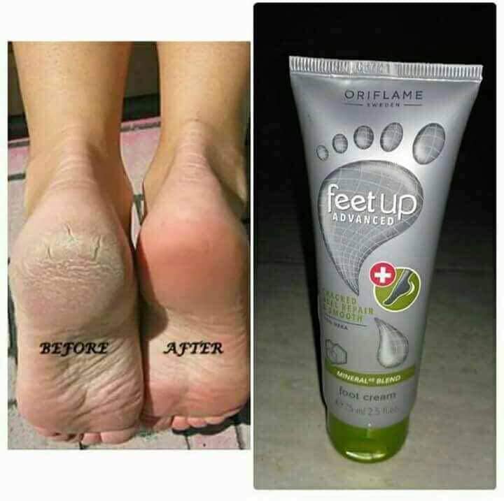 foot cream for dark spots