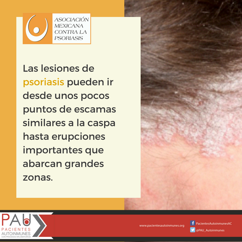 AMCPSO's tweet photo. La #psoriasis es una enfemedad crónica intermitente caracterizada  principalmente por escamas y manchas rojas en la piel que causan comezón  y a veces dolor @PAU_Autoinmunes  @IAPOvoice  @PsoriasisIFPA @RedAlapso  @alianza_latina @RedAcceso @psoriasis https://t.co/7e93suteE0