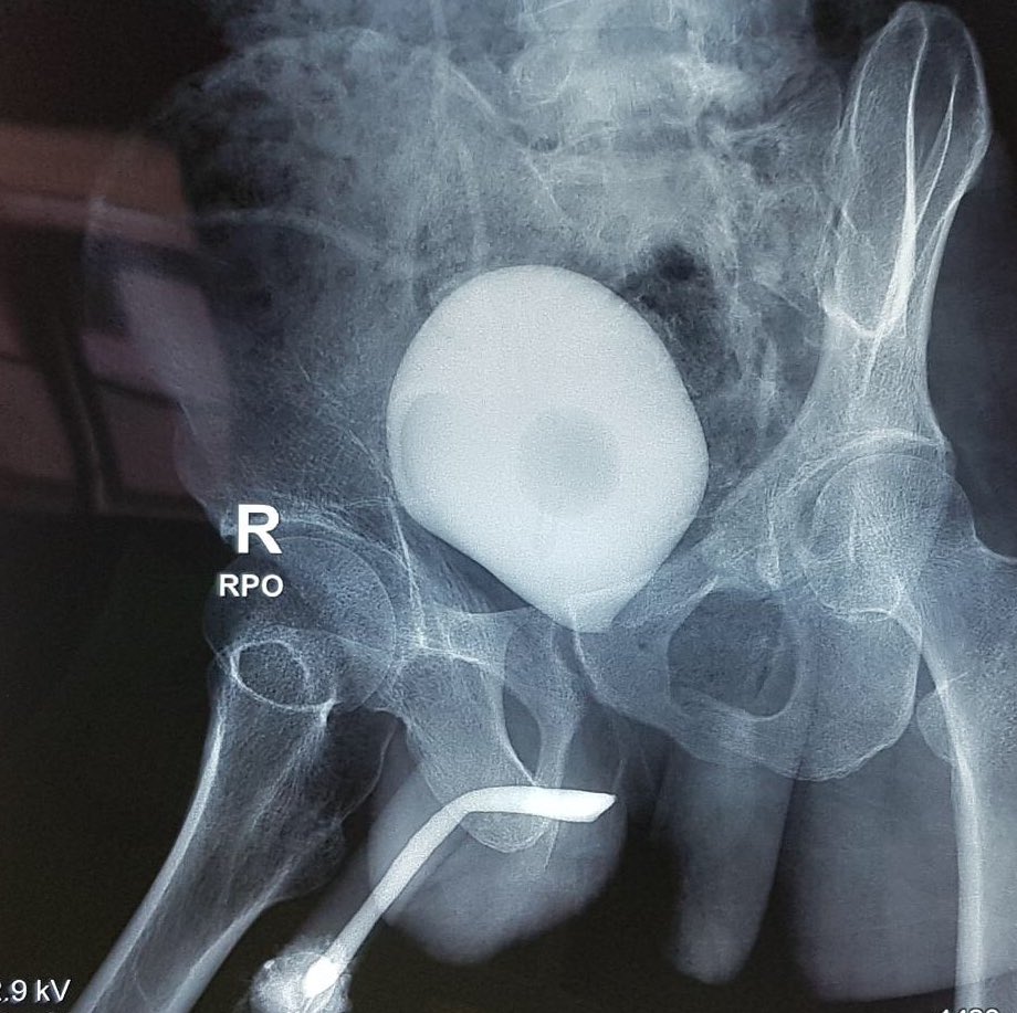 Paksi_PAS's tweet photo. Back to routine after a long break, the same patient, different MCU-RGU evaluation. Proper pre op management is important to obtain optimal outcome. For Reconstructive urologist who perform the surgery, please do your own radiologic exam #reconstructiveurology #pfudd #pfui https://t.co/zqmDXm5dWZ