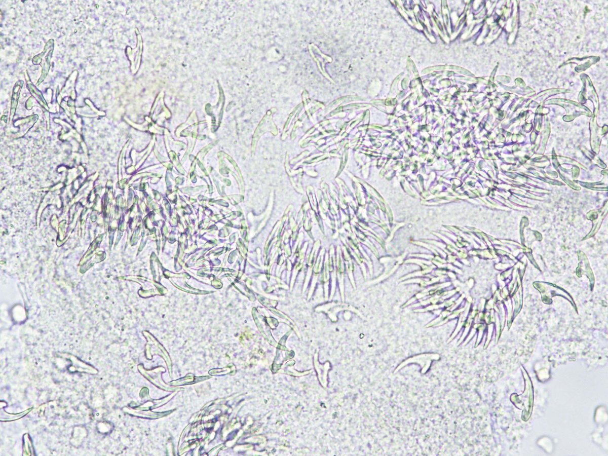 The Parasite Case of the Week 514 is up - liver cyst aspirate: parasitewonders.blogspot.com/2018/10/case-o…  #mayopath #pathology #parasites #MayoClinicMicro #asmclinmicro <a href="/Pathologists/">CAPathologists</a> <a href="/JMGardnerMD/">Jerad Gardner, MD</a> <a href="/mayocliniclabs/">Mayo Clinic Labs</a> <a href="/ASTMH/">ASTMH</a> <a href="/AmSocParasit/">ASP-Parasitologists</a>
