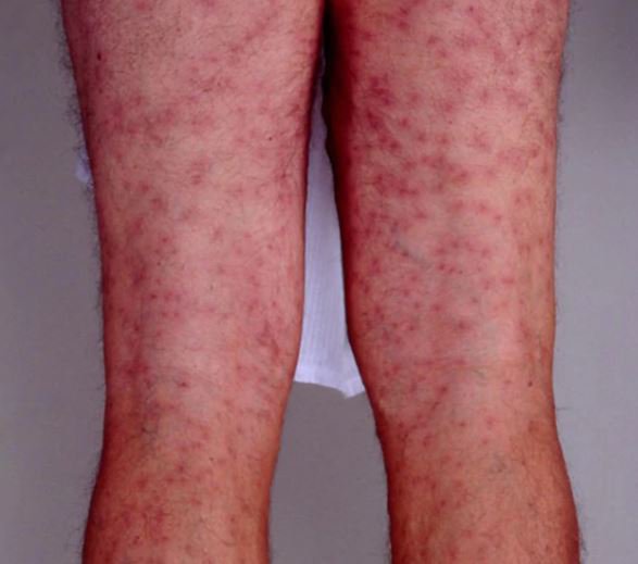WFP_community's tweet photo. https://t.co/XNdG8ukxUn
What is Swimmer's Itch and how to avoid it this summer! https://t.co/C90tyUy7uw