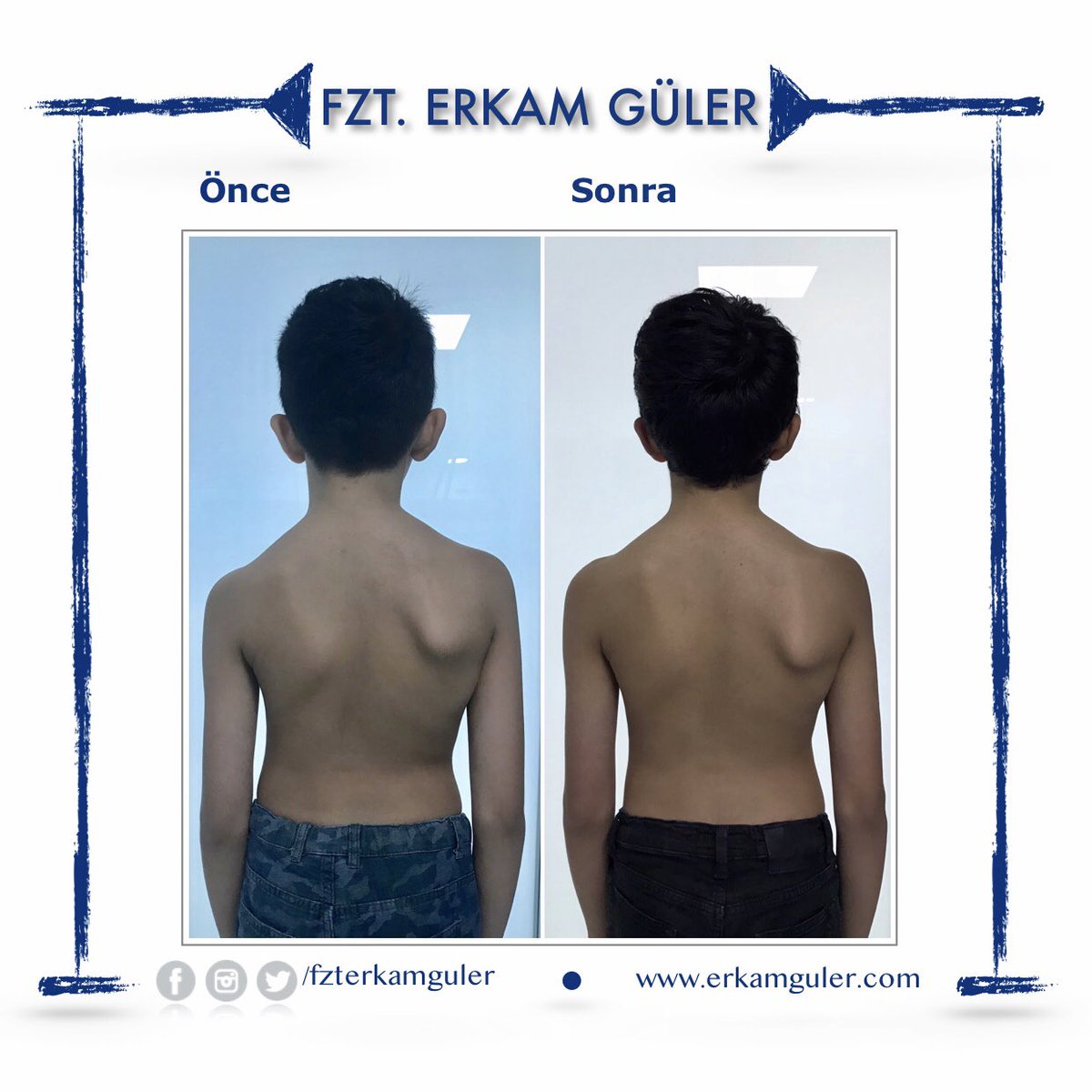 fzterkamguler's tweet image. 13 yaşında Skolyoz şikayeti ile gelen hastamızın 15 seans Schroth 3D Skolyoz Egzersizleri ile postüründeki değişim! 👏👍

#schrothterapi #schrothmethod #schroth #skolyoztedavisi #skolyoz #scoliosis