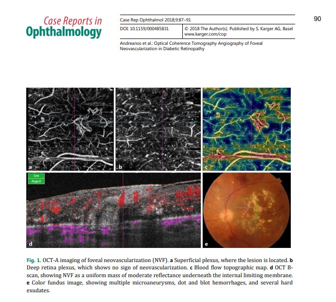 Science_Open's tweet photo. ‘Optical Coherence #Tomography #Angiography of #Foveal #Neovascularization in #Diabetic #Retinopathy’, an article in the #ScienceOpen collection '#Diabetes: Karger Topical Article Package' @KargerPublisher. #fbm18
https://t.co/QRregRjRfy https://t.co/sQzSAhMqmX