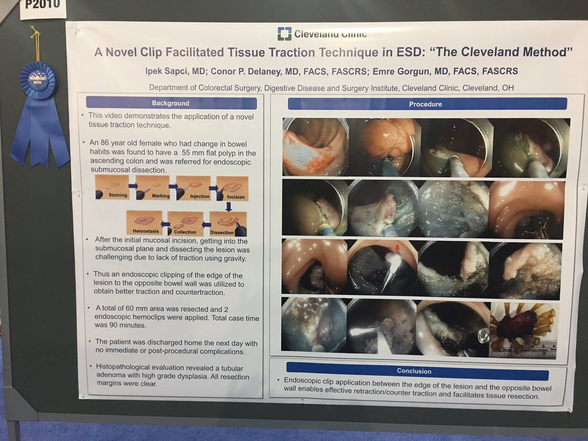 Emre Gorgun (@emregorgunmd) on Twitter photo Proud to receive the Presidential Award at the #ACG2018 with “The Cleveland Method” using the clip facilitated traction in colonic ESD <a href="/ipek_sapci/">Ipek Sapci, MD</a> <a href="/ConorDelaneyMD/">Conor Delaney</a> <a href="/ScottRSteeleMD/">Scott R. Steele</a> <a href="/MadhuSanakaMD/">Madhu Sanaka</a> <a href="/MRegueiroMD/">Miguel Regueiro</a> @amitbhatt31 <a href="/JohnVargoMD/">John Vargo</a> <a href="/MattKaladyMD/">Matthew Kalady</a> <a href="/SWexner/">Steven D Wexner MD, PhD</a> <a href="/sasbanerjee/">Sas Banerjee</a> Proud to receive the Presidential Award at the #ACG2018 with “The Cleveland Method” using the clip facilitated traction in colonic ESD <a href="/ipek_sapci/">Ipek Sapci, MD</a> <a href="/ConorDelaneyMD/">Conor Delaney</a> <a href="/ScottRSteeleMD/">Scott R. Steele</a> <a href="/MadhuSanakaMD/">Madhu Sanaka</a> <a href="/MRegueiroMD/">Miguel Regueiro</a> @amitbhatt31 <a href="/JohnVargoMD/">John Vargo</a> <a href="/MattKaladyMD/">Matthew Kalady</a> <a href="/SWexner/">Steven D Wexner MD, PhD</a> <a href="/sasbanerjee/">Sas Banerjee</a>