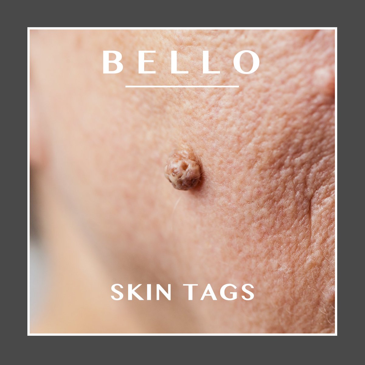 BelloBeauty's tweet photo. Skin Tags 🌟

Fed up of unwanted skin tags?.. Do you just want them gone?..  Well look no further then. 😘 Bello can get rid of all unwanted skin tags you may have. ❤

Call or Text to Book 07810892236
https://t.co/9S1ERs7lFr
Download App - Bello The Salon https://t.co/yuDTghVHmI