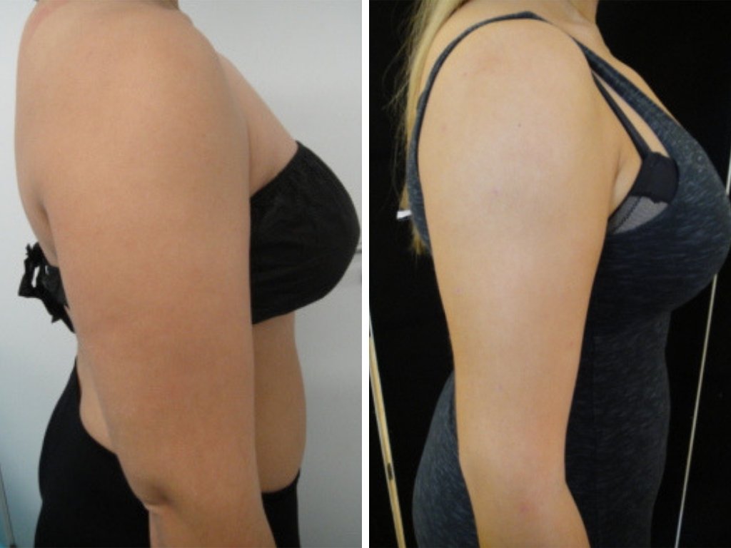 privateclinic's tweet photo. Before and after our popular, walk-in-walk-out #microliposuction procedure. The #fatremoval & #bodysculpting treatment can be carried out on the flanks, abdomen, male chest, bingo wings, knees, inner thighs, female breasts and double chin. https://t.co/7ajNsys9Sa https://t.co/bQp9XRLWBZ