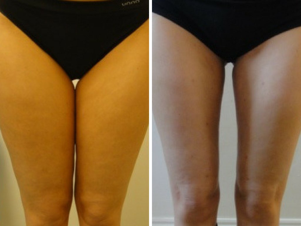 privateclinic's tweet photo. Before and after our popular, walk-in-walk-out #microliposuction procedure. The #fatremoval & #bodysculpting treatment can be carried out on the flanks, abdomen, male chest, bingo wings, knees, inner thighs, female breasts and double chin. https://t.co/7ajNsys9Sa https://t.co/bQp9XRLWBZ