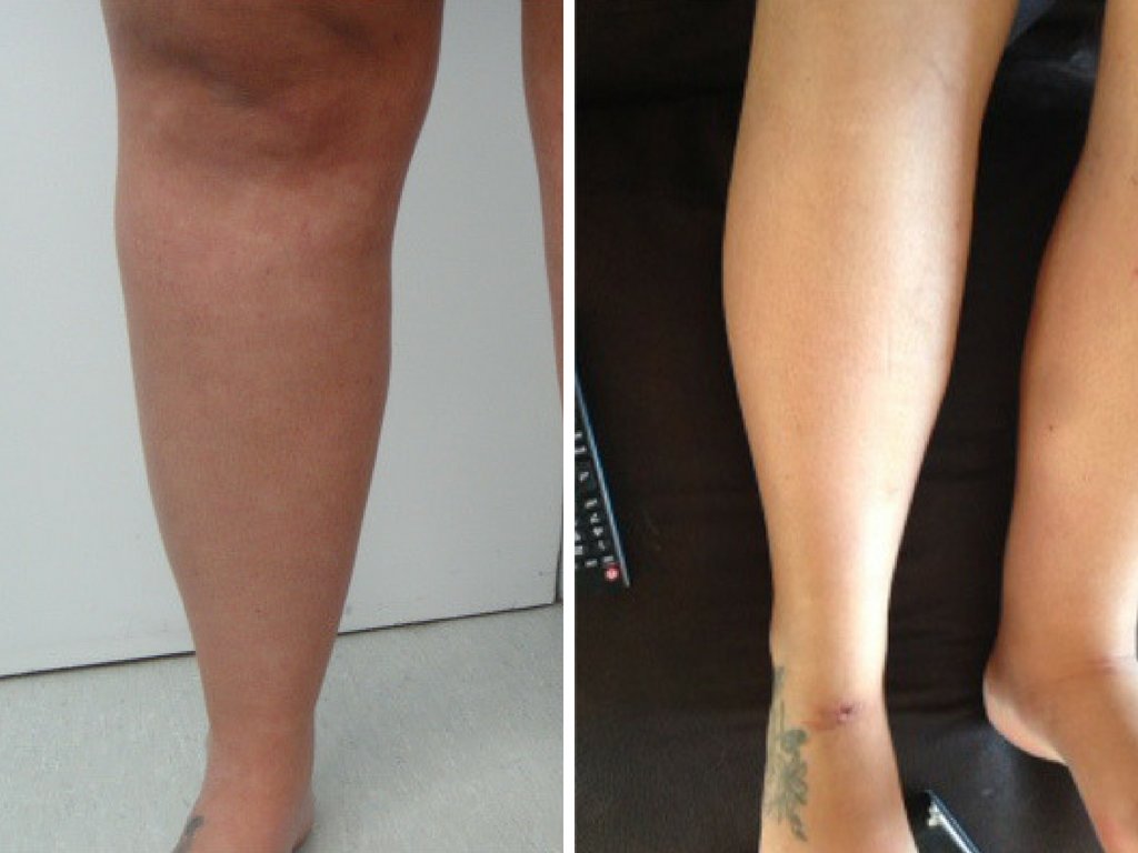 privateclinic's tweet photo. Before and after our popular, walk-in-walk-out #microliposuction procedure. The #fatremoval & #bodysculpting treatment can be carried out on the flanks, abdomen, male chest, bingo wings, knees, inner thighs, female breasts and double chin. https://t.co/7ajNsys9Sa https://t.co/bQp9XRLWBZ