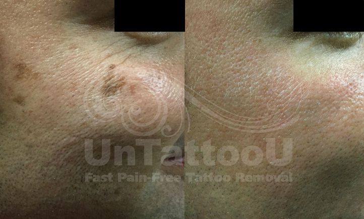 UntattooU's tweet photo. Revitalize Your Skin @ UnTattooU! 
Contact our office today [📱703.214.6492] or visit our website https://t.co/VHIVh69CUK to schedule! 

#UnTattooU #PicoSure #skinrevitalization #PicoFocus #skincare #wrinkles #finelines #acnescarsremoval #acnescars #skin #beauty #aesthetics https://t.co/2wjgYZdIZU