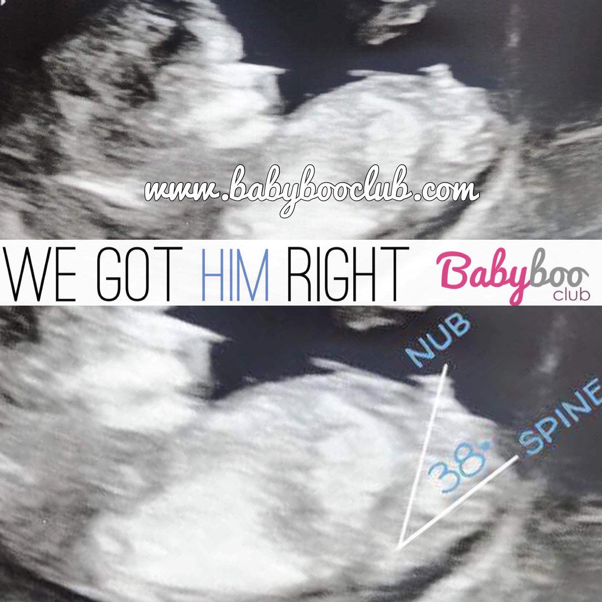 BabyBooClub's tweet photo. We got him right! #nubologists #nubexperts #nubtheory #baby #genderprediction #itsaboy #boynub #wegothimright #12weekscan #pregnancy #boy #excepting #babyboy #ultrasound #scan submit your pics here to find out your babyโs gender, as early as 12wks >> https://t.co/dsY0AzUZLj ๐๐ https://t.co/62eIXd3TfJ