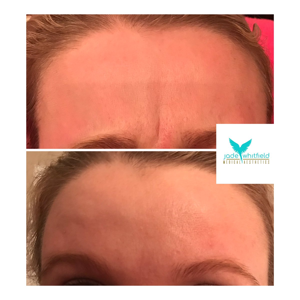 Great results at the two week review, 1st picture before and second picture after 👌 smooth forehead with movement intact for the refreshed not frozen look. #botox #twoweekreview #aesthetics #allergan #allerganbotox
