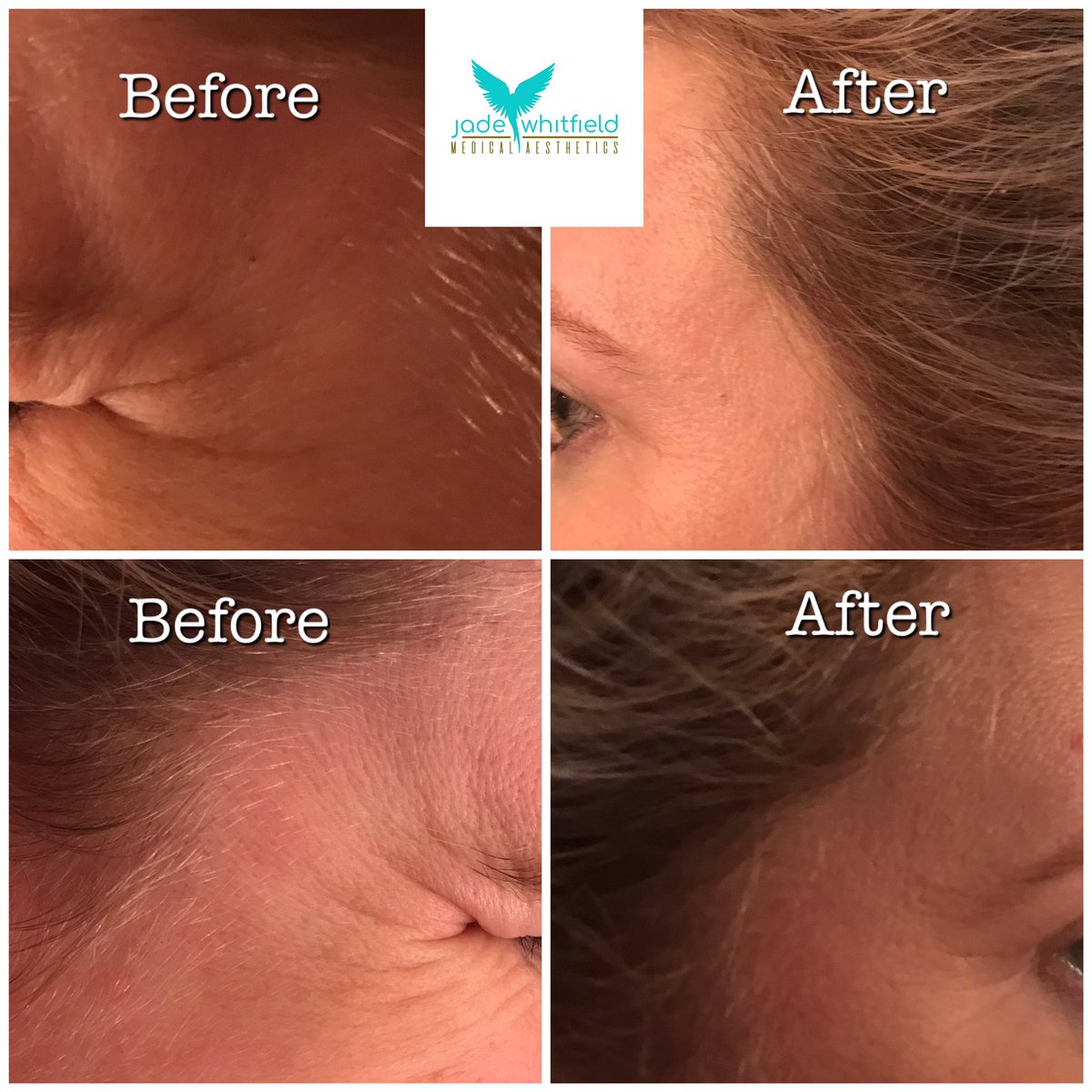 More lovely results at the two week review👌 no more crows feet and achieving the refreshed not frozen look. #botox #twoweekreview #aesthetics #allergan #allerganbotox
