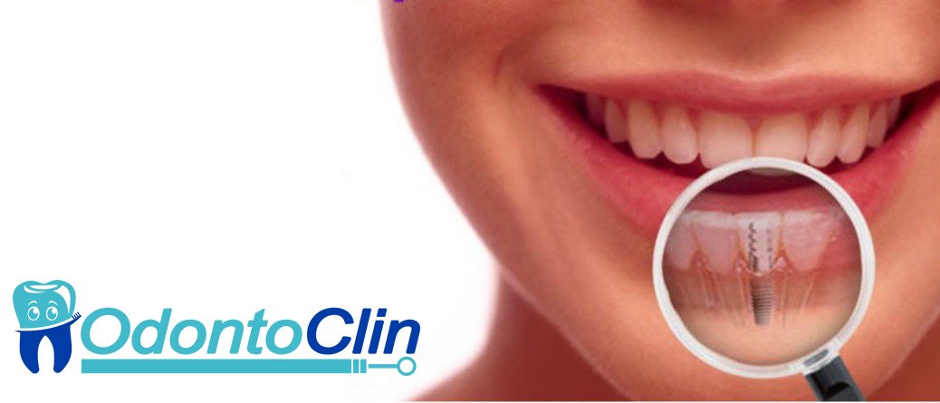 odontoclinCL's tweet photo. Las técnicas implantológicas entregan múltiples posibilidades de tratamiento, lo que ha contribuido al campo de la rehabilitación protésica.
La implantologia tiene un grado elevado de precisión, funcionalidad, comodidad y belleza, además de alta durabilidad y calidad. https://t.co/O95YqnNbwI