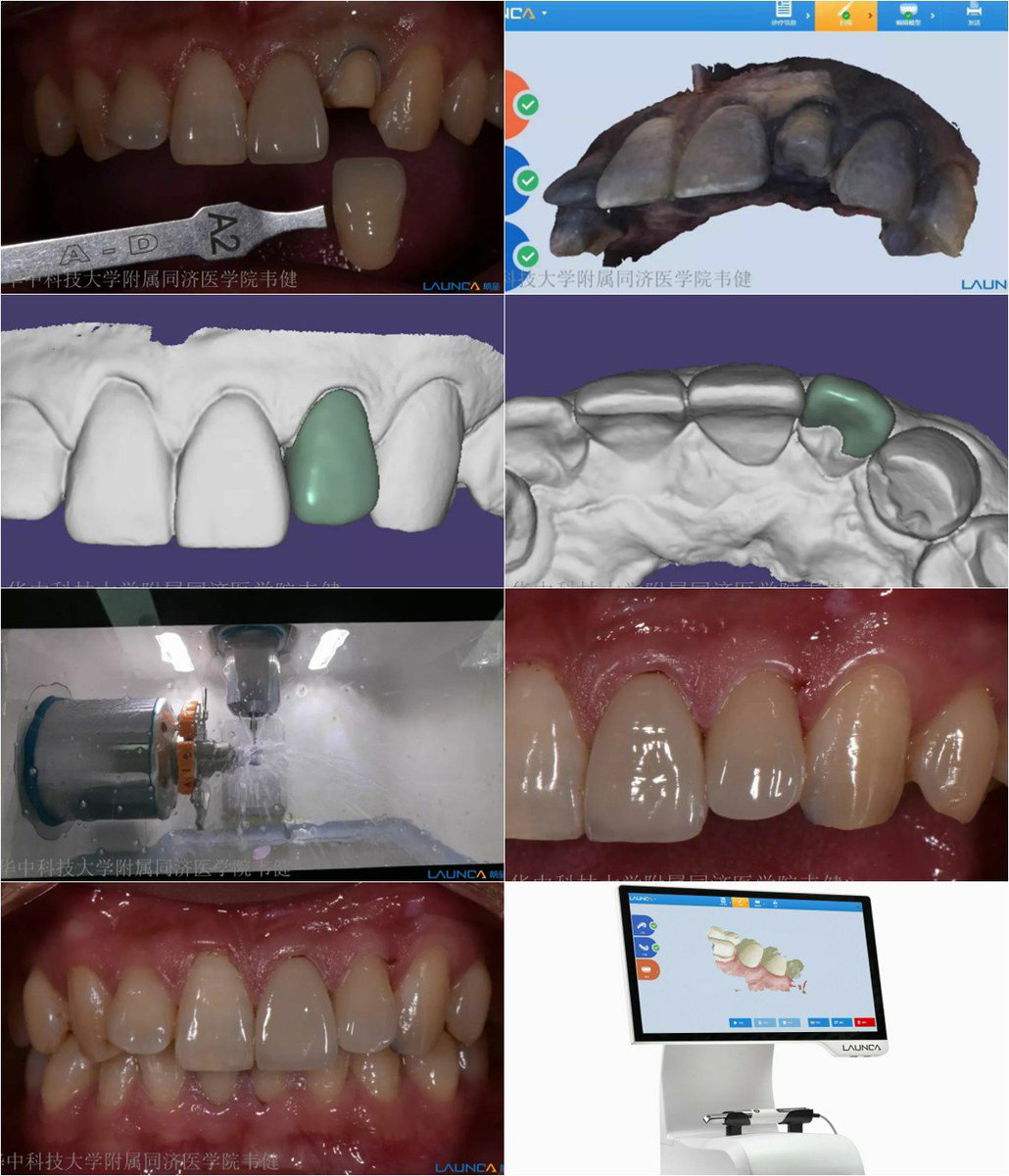 Launca_dental's tweet image. Guangdong Launca Medical Device Technology Co., Ltd.
发布者：Poppy Han · 刚刚 · 
All-ceramic veneer restoration with Launca DL-100 intraoral scanner. Transparency of treatment, no fear, 1.5 hours bringing the perfect clinic experience.  #digitalimpression #intraoralscanner  #CAD