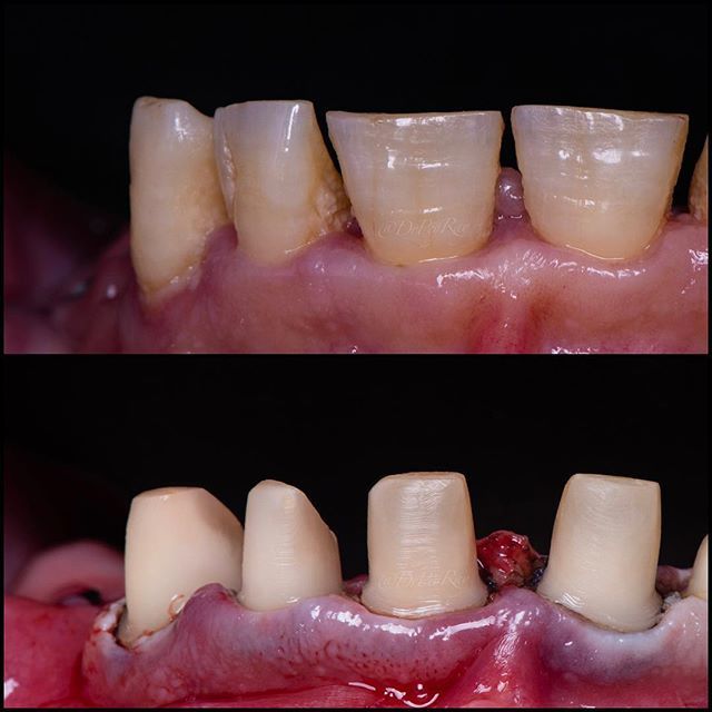 drpeyray's tweet photo. "Form follows function." Excuse the hygiene🤦🏻‍♂️Patient promised they'll do better 🤷🏻‍♂️ #crownprep #dentaleducation #dentistry #drpeyray #emax #emaxpress #labtechnician #wednesdayaddams #wednesdaywisdom #mynewsmiledental https://t.co/CI0EYYeTl4 https://t.co/0sWom7eEua