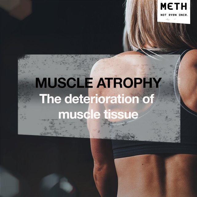 IDMethProject's tweet image. Methamphetamine users often lose a lot of weight, and much of it can come from the damaging reduction of muscle mass and function. #NotEvenOnce