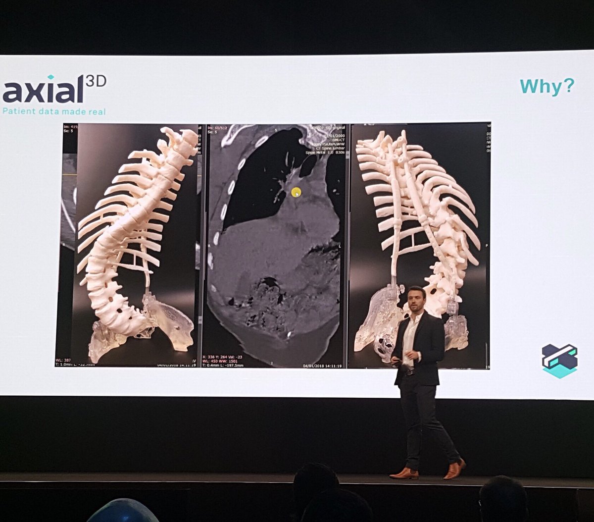 Founder & CEO Daniel Crawford talks about axial3D’s development of automated segmentation solutions for 3D printing using AI. We’re harnessing innovation to personalise healthcare.  #gtc2018 #AI #medical3dprinting  #healthcareinnovation #surgery #3dprinting