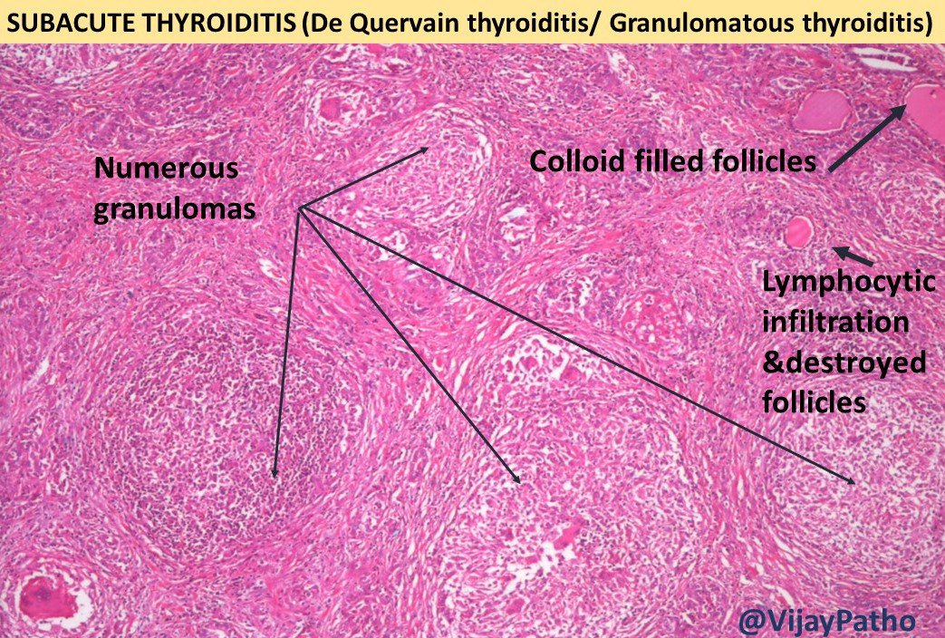 de quervain thyroiditis histology)