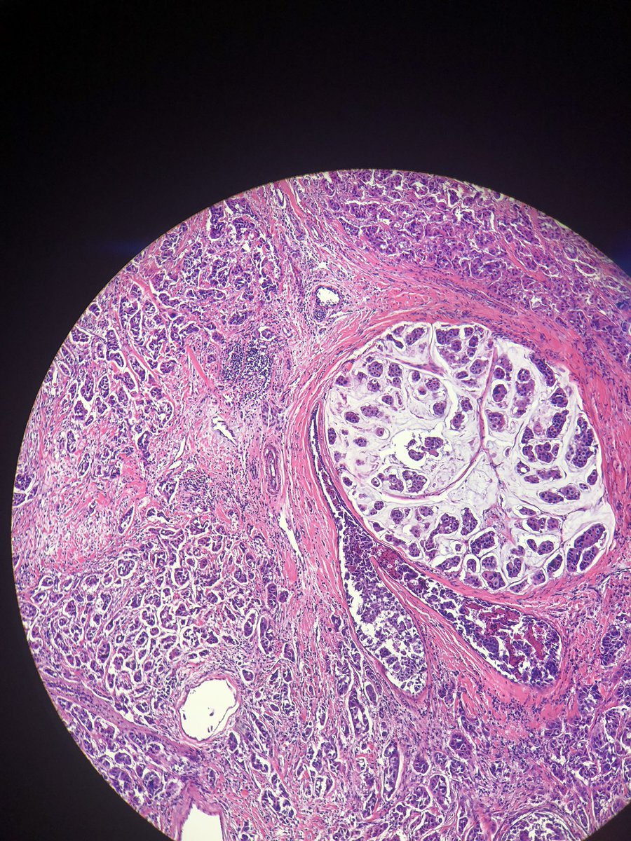 Neuygn's tweet photo. A beautiful case of invasive ductal carcinoma with micropapillary and mucinous micropapillary features. #breastpathology #breastcancer @BreastPathology @tim_dalfonso @TheEstherCheng @FKhaniPath @Pathologista @histopathology https://t.co/v6JoJ2ayjm