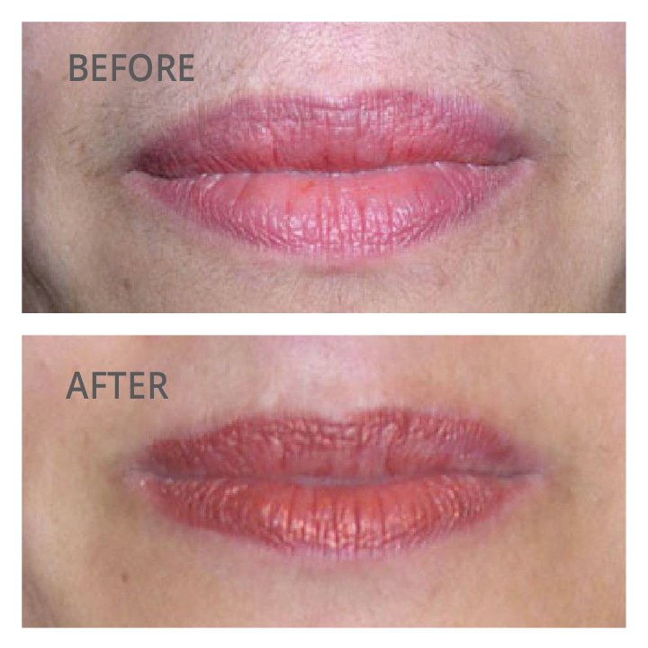 For The Love Of Laser On Twitter My Laser Hair Removal Sessions With For The Love Of Laser Were Easy And Painless I Left Every Treatment Thinking Why Didn T I Do This