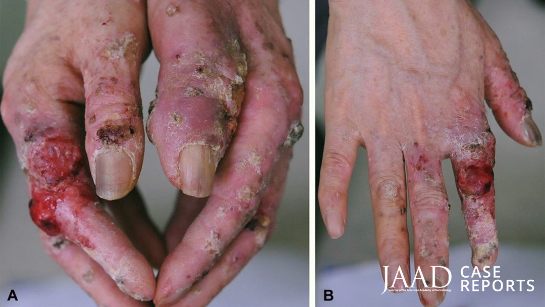JAADjournals's tweet photo. As an orthopedic surgeon, the patient had been exposed to radiation from C-arm fluoroscopy for 20 years. Open access case report: https://t.co/gTrAtvqJYo https://t.co/5kJPcVPuHF