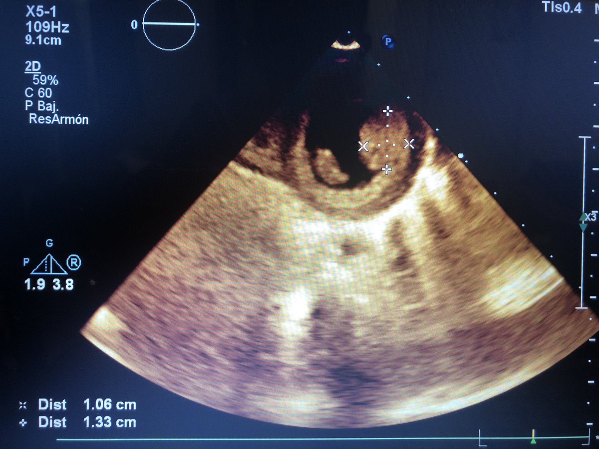 LaLoTomas3's tweet image. Rabdomioma Cardiaco #LoViEnLaRaza #CardioPedia