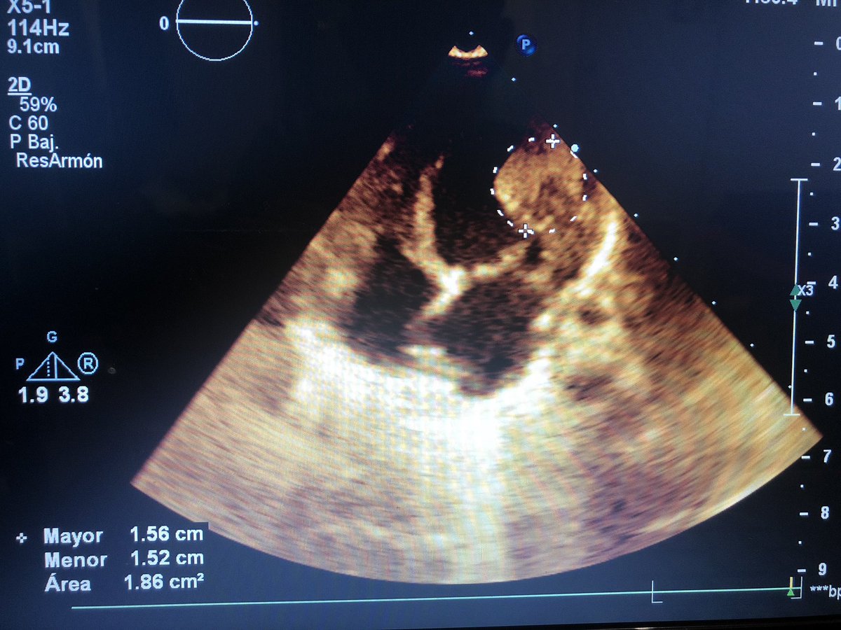 LaLoTomas3's tweet image. Rabdomioma Cardiaco #LoViEnLaRaza #CardioPedia