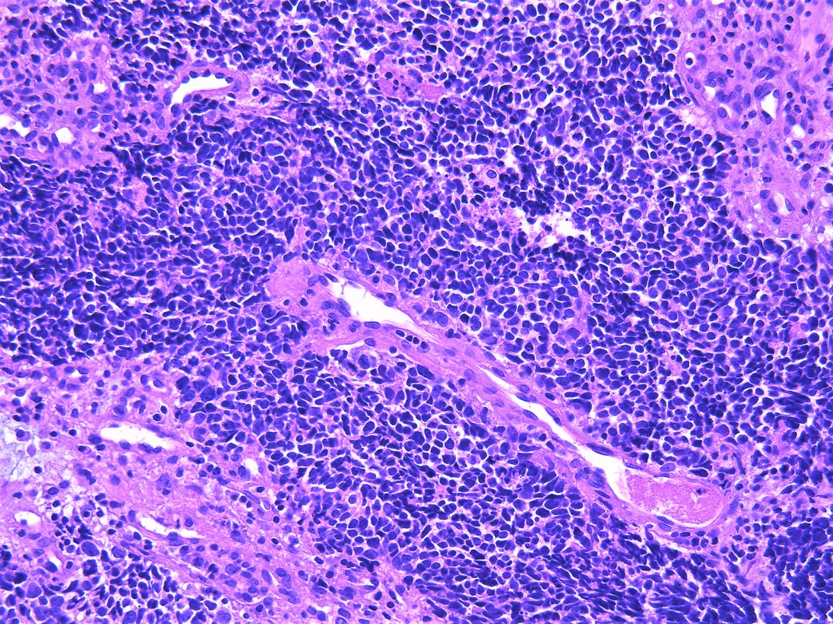 Patholwalker's tweet photo. Small cell carcinoma of lung. Bronchus, biopsy. #pathology #Pulmopath https://t.co/VVn5nYWi45