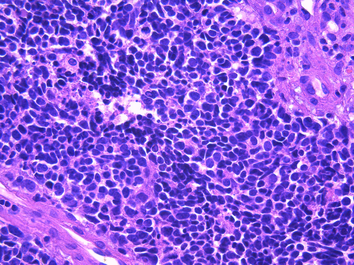 Patholwalker's tweet photo. Small cell carcinoma of lung. Bronchus, biopsy. #pathology #Pulmopath https://t.co/VVn5nYWi45