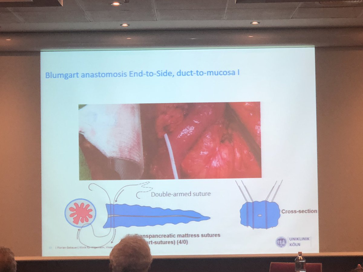 polom_karol's tweet photo. Second day of #ESSO38 #pancreaticcancer analysis of #blumgartanastomosis and to Drain or not to drain - this is still a question 😳 #some4surgery #surgicalresearch #pancreaticsurgery @arek_spychala https://t.co/brTBhzMGxD