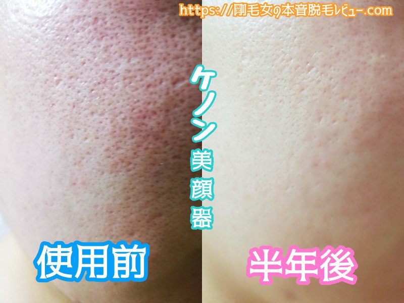 男並み剛毛女ことアンジェリーナ בטוויטר ケノン 美顔器 ケノン美顔器 ニキビ跡 シミ たるみ リフトアップ 毛穴 スキンケア セルフエステ エステ 詳細は概要欄のurlから 男並み剛毛女ことアンジェリーナ בטוויטר ケノン 美顔器 ケノン美顔器 ニキビ跡 シミ たるみ リフトアップ 毛穴 スキンケア セルフエステ エステ 詳細は概要欄のurlから