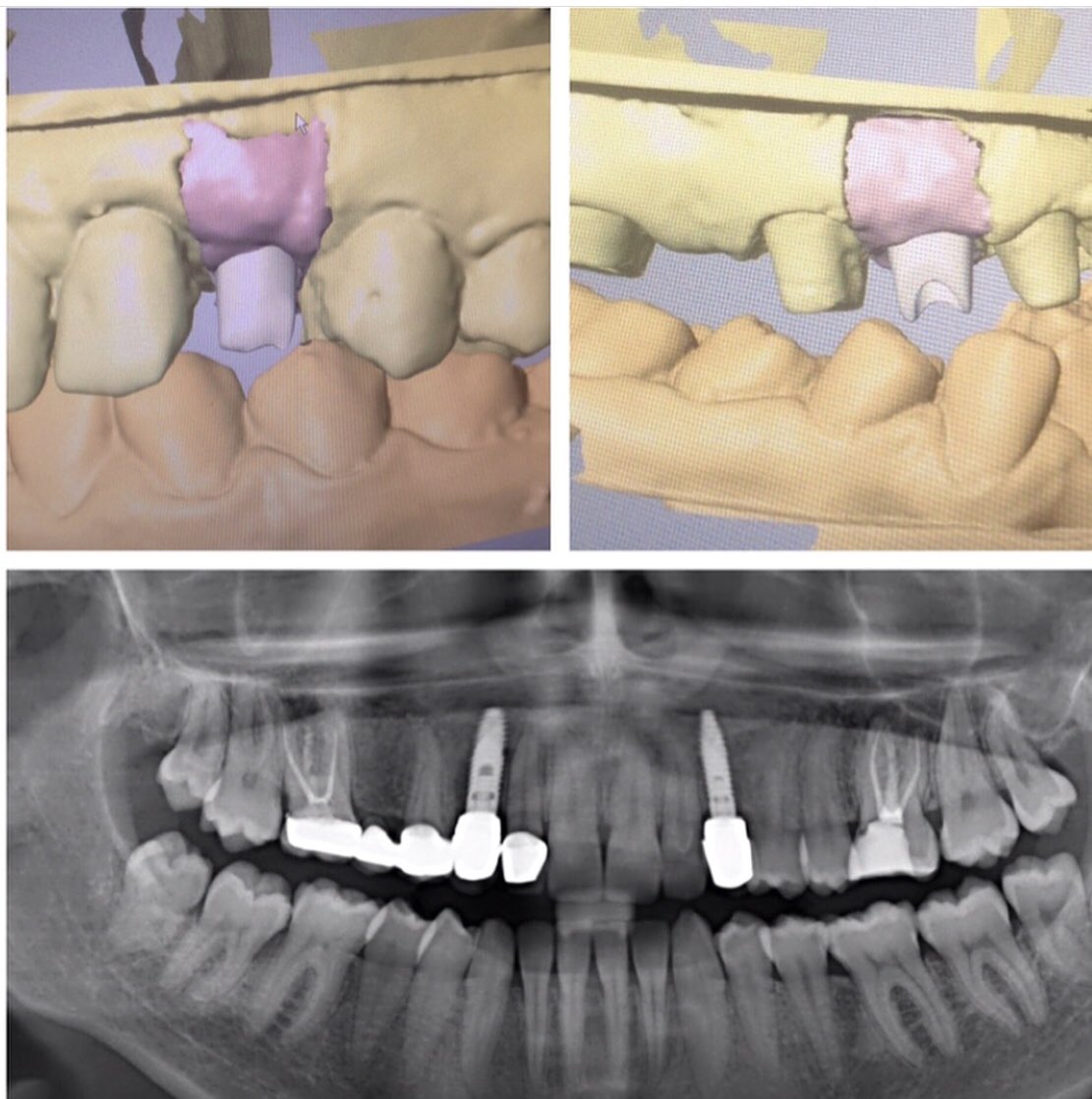 Uzun bir yolculuğu tamamladık. Gömülü köpek dişlerini damaktan alıp aynı seans implant ameliyatını tamamladık. İyileşme sonrasında implant üst yapısını CAD-CAM ile planlayıp zirkon alt yapılı protezini ürettik.