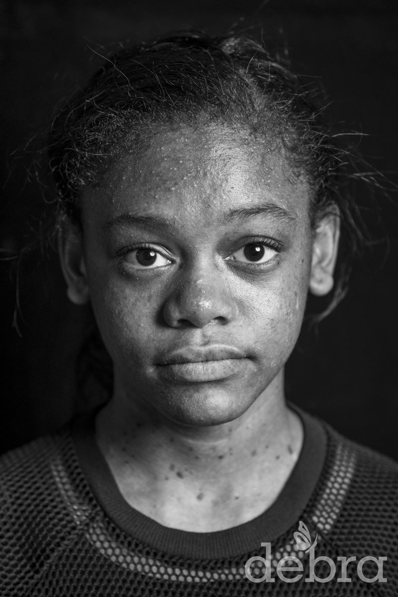 debraOfAmerica's tweet photo. "Although some days I struggle to walk, I still give 100% effort in sports and I am very competitive." Read more + share Amaya's #EverydayEB story in honor of #EBweek: https://t.co/pzdDk2NSYD https://t.co/JNaojcWwpk