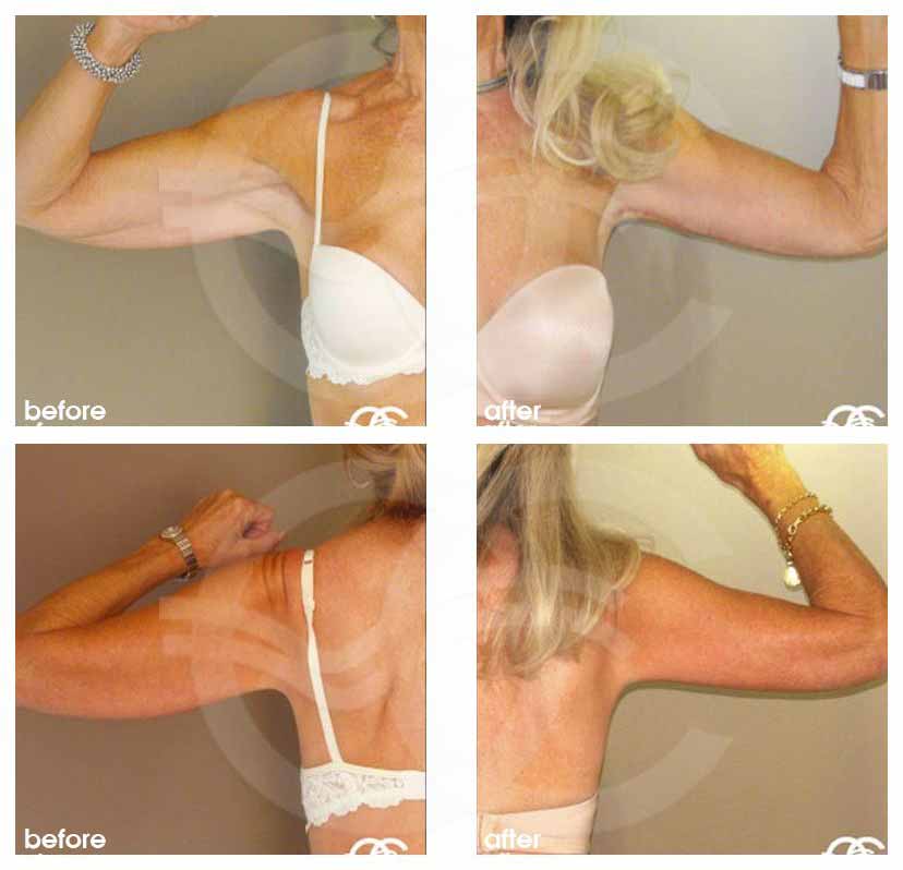 oceancli's tweet image. Want to fix your sagging arms? We answer your questions about arm lift surgery on our blog: ow.ly/iysY30mbEc0