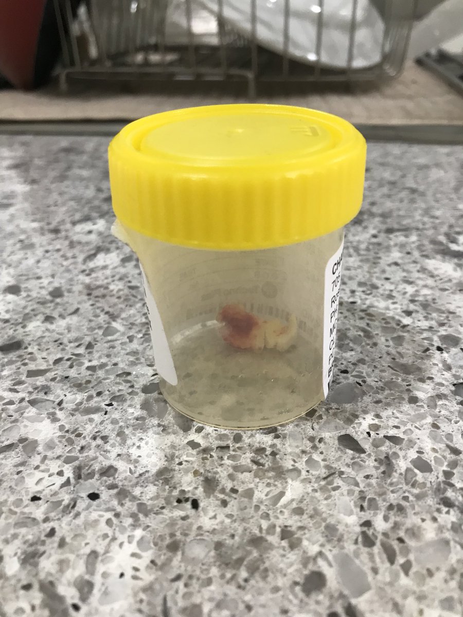 MandaBianca's tweet photo. Hey look at this gross chunk of cartilage the surgeon took from my knee 🤮 https://t.co/uTXUTmouON