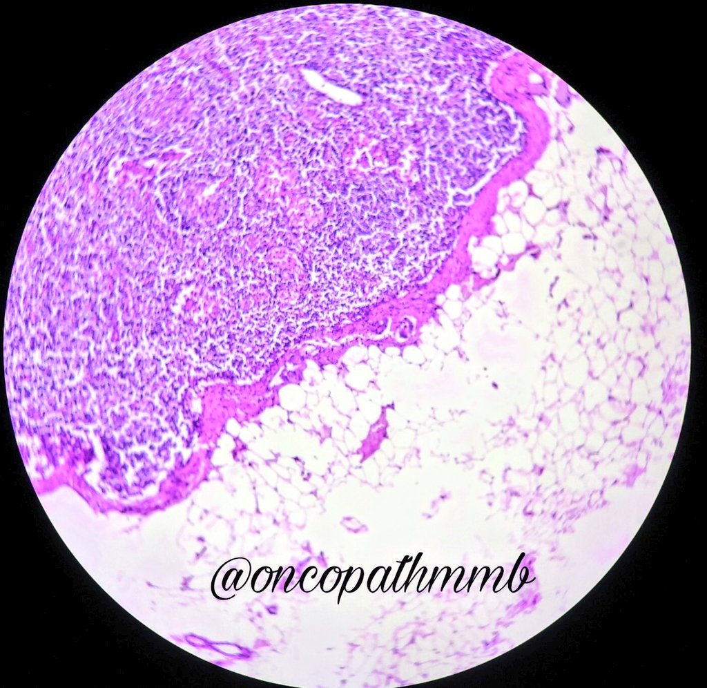oncopathmmb's tweet photo. ISOLATED TUMOR CELLS in Ax.LN 
▶️Cluster of less than 200 tumor cells or single tumor cells or size measuring less than 0.2mm in a single cross section.
▶️Reported as pN0(i+)
▶️Not to be included in a positive node count for N classification.
#breastpath #LPpath #pathologists https://t.co/U1Mkq1rIIM